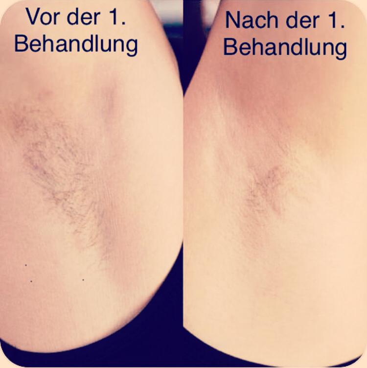 Laserbehandlung Vergleich nach einer Sitzung