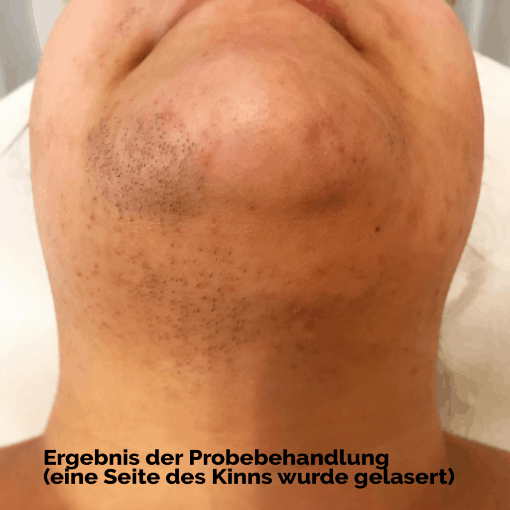 Intimbereich laserbehandlung Haarentfernung mit