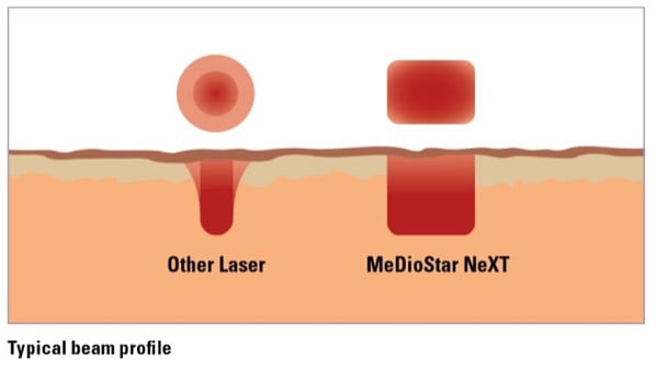 Mediostar Next von Asclepion im Vergleich mit herkömmlichen Lasergeräten